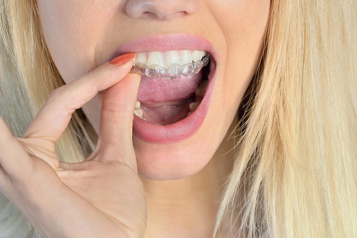 Reasons to Choose Invisalign Over Metal Braces - Spy Hill Dental